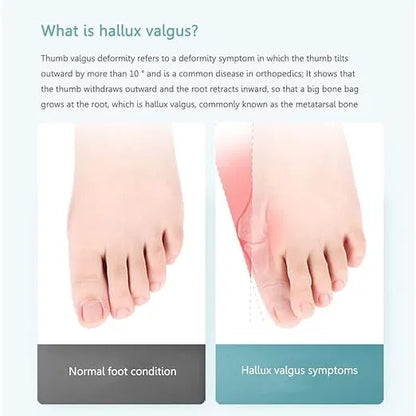 Adjustable Toe Straightener Bunion Corrector for Men and Women Pain Relief Toe Aligner